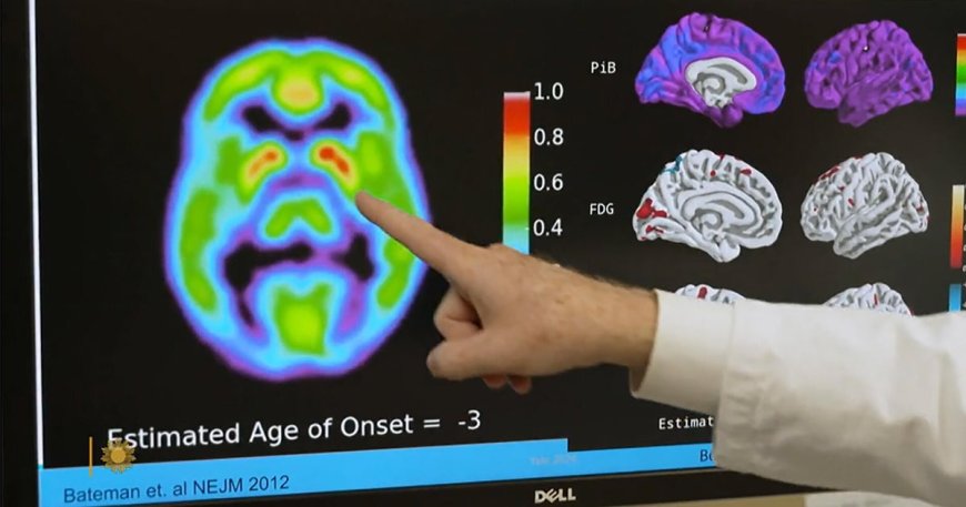 Promising clinical trials in Alzheimer's prevention