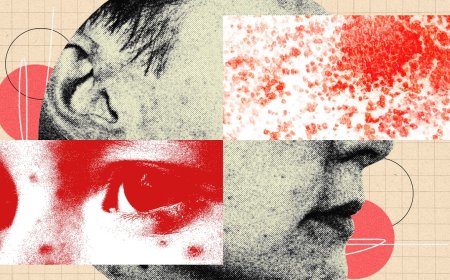 You Should Be More Freaked Out by Shingles