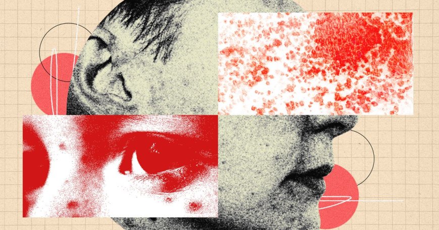 You Should Be More Freaked Out by Shingles