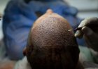 How Turkey Hacked the Hair Transplant Industry