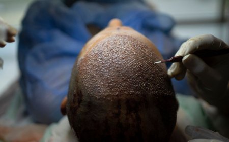 How Turkey Hacked the Hair Transplant Industry