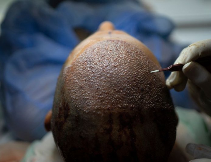 How Turkey Hacked the Hair Transplant Industry