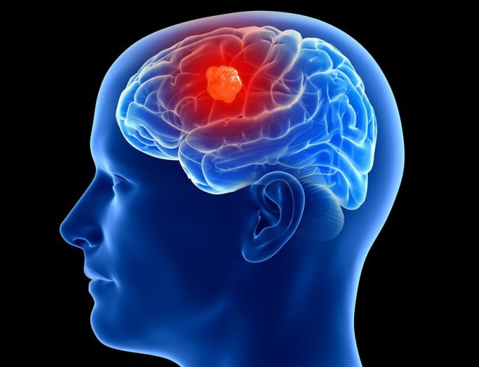 3 People Have Gotten Cancer-Detecting Implants in Their Brains